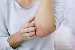What to do about itchy skin in winter
