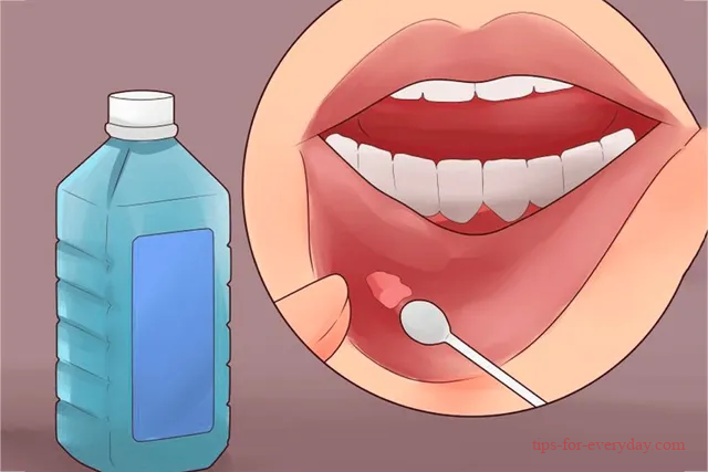 How to cure mouth ulcers quickly?1